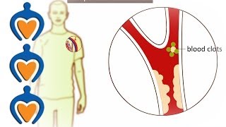 Thrombosis  What is it and how is it treated [upl. by Vange874]