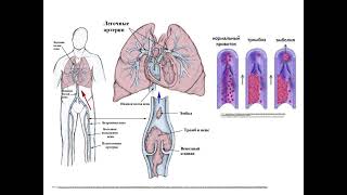 Thrombosis EmbolismViolations microcirculation [upl. by Allesor]