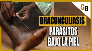 Dracunculiasis  El Parásito de 1 metro que habita bajo La Piel  El Gusano de Guinea EXPLICADO [upl. by Eybba]