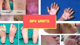 HPV Warts Symptoms – Causes Symptoms and Pictures of HPV Virus Warts in Men women [upl. by Yessac137]