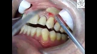 Abscess tooth removal  Tooth Abscess Extraction [upl. by Yedok523]