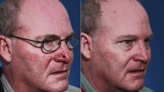 Nasal Reconstruction After MOHS Surgery [upl. by Isolt880]