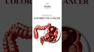 Understanding Colon Cancer Risk Factors and Causes  Dr Sharvani Duba Arete Hospitals coloncancer [upl. by Merth273]