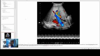 Hepatic Venoocclusive Disease [upl. by Vanna266]