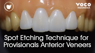 Spot Etching Technique for Provisionals Anterior Veneers Temporary Veneers ǀ Structur 3  VOCO GmbH [upl. by Bluhm]