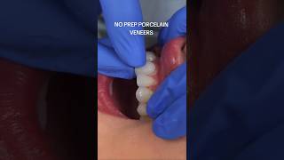 INSTANT Veneers With NO Teeth Damage [upl. by Etnaik732]