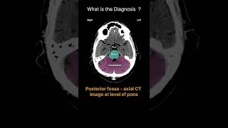 Posterior fossa  axial CT image at level of pons CT Brain Anatomy Quiz 30radiologychannel007 [upl. by Laverna]