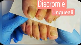 Unghie ispessite tutorial step by step Pedicure di anziani e come risolvere [upl. by Notlek]