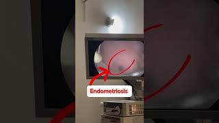 Hysteroscopy What does endometriosis look like Removal endometrial polyp [upl. by Derr]