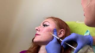 Acne Scar Treatment with Bellafill dermal filler in Seattle at Well Medical Arts [upl. by Herstein]