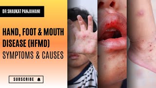 Hand Foot amp Mouth Disease HFMD Symptoms amp Causes [upl. by Attiuqihc297]