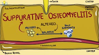 Suppurative Osteomyelitis of the jaw [upl. by Suedama]