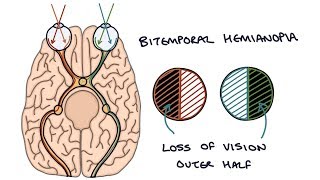 Understanding Bitemporal Hemianopia [upl. by Ahsenra]