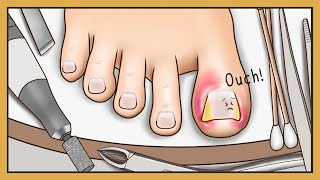 Tingle ASMR Animation Ingrown Toenail Removal with Stimulating Sound  Ondong  Happy Lemon [upl. by Rudie356]