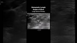 Neck Lymph Nodes ultrasound imaging cancerawareness cases [upl. by Fablan]