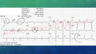 EKG befunden leicht gemacht EKG Beispiele [upl. by Elletnuahs]