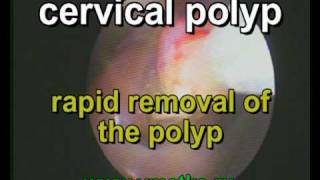 Rapid removal of the cervical polyp [upl. by Kuth486]