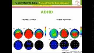 qEEG A Useful Tool for Diagnosis and Treatment Evaluation [upl. by Aenit]