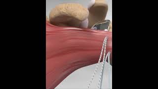 Subscapularis tendon repair  animationshorts shortsfeed youtubeshorts viralshorts [upl. by Jelena]