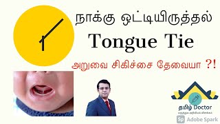 நாக்கு ஒட்டி இருத்தல்  Tongue Tie in Babies  When to Intervene  தமிழ் [upl. by Map]