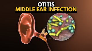 Middle Ear Infection Otitis Media Causes SIgns and Symptoms Diagnosis and Treatment [upl. by Llert568]