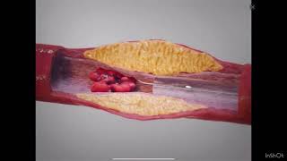 Atherosclerosis Procedure Medicalschooleasylearning [upl. by Laemsi340]