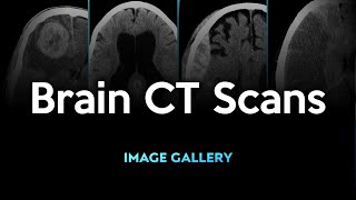 Brain CT Scans Image Gallery [upl. by Dickey733]