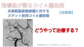 Case12 医療者向け【実践編】脳底動脈瘤ステント併用コイル塞栓術 [upl. by Gefell]