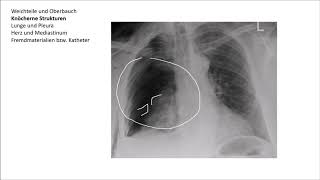 Röntgen Thorax Befundung [upl. by Furiya]