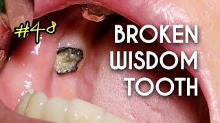 ASMR Broken Tooth Extraction [upl. by Nivlak]