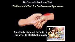 De Quervain Syndrome Test  Everything You Need To Know  Dr Nabil Ebraheim [upl. by Sadella870]