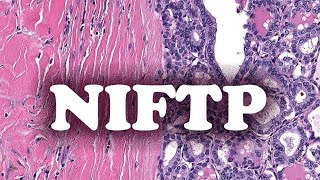 LE NEOPLASME FOLLICULAIRE AVEC CARACTERISTIQUES NUCLEAIRES PAPILLAIRESLIKE NIFTP  PATHOLOGIE [upl. by Aibsel907]