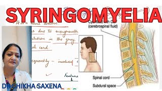 Syringomyelia spinal cord applied aspect [upl. by Rafe]