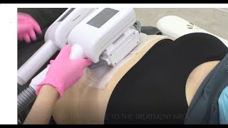 Fat Freezing treatment before and after with Dr Leah [upl. by Scholz]