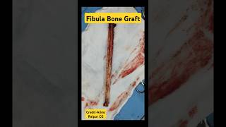 Fibula Bone Graft 🔥 फ़िबुला ग्राफ्ट fibula fibulafracture grafting bonefracture [upl. by Rubin]