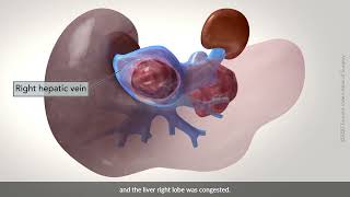 Right hepatectomy with cava resection and oophorectomy [upl. by Ahsuat]