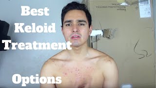 How To Treat Keloids Treatment Options For Keloids [upl. by Tesler]