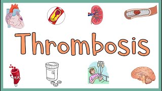 Thrombosis  Definition Causes Types Morphology Fate of a Thrombus amp Clinical manifestations [upl. by Yrral109]