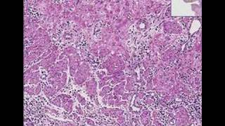 Histopathology Esophagus Herpes esophagitis [upl. by Aznofla]