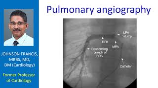 Pulmonary angiography [upl. by Raman358]