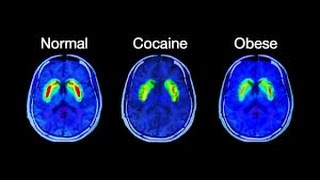 Sugar vs Cocaine [upl. by Vallery]