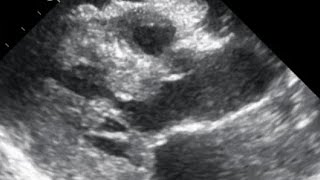 CARDIAC AMYLOIDOSIS ECHOCARDIOGRAPHY CASE1  Dr Alexandru Mischie [upl. by Flann]