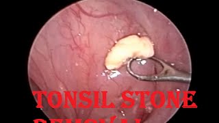 Tonsil Stone  Infected Cheesy Material Removal from Tonsillar Crypt [upl. by Lancelot97]