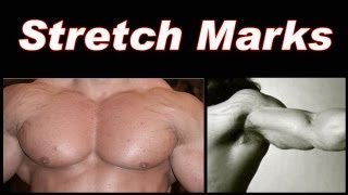 Bodybuilding Stretch Marks [upl. by Aynnat]