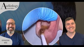 IRRIGATION OF HARD EAR WAX PLUG amp STUCK OTIP EXTRACTION EP832 [upl. by Adnirod715]