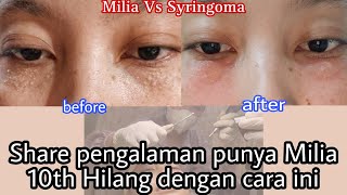 Hempas Milia Vs Syringoma part1 bisa hilang permanen gak ya 10th milia ada di wajah [upl. by Tollman]