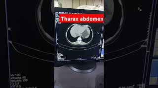 abdomen ct scan ct scanabdomenctanatomy ct scan [upl. by Jerroll]