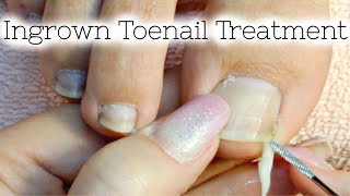 Pedicure Tutorial Ingrown Toenail Treatment At Home How to Recut Nail Groove to Eliminate Pain [upl. by Akeemahs414]