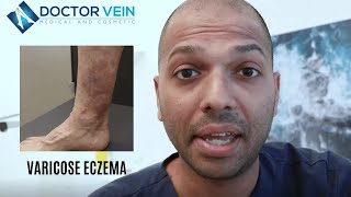 Varicose Eczema Itchy Rash near Varicose Veins [upl. by Aicelf]