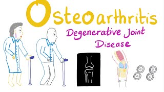 Osteoarthritis OA  Introduction  Rheumatology Series [upl. by Ives]